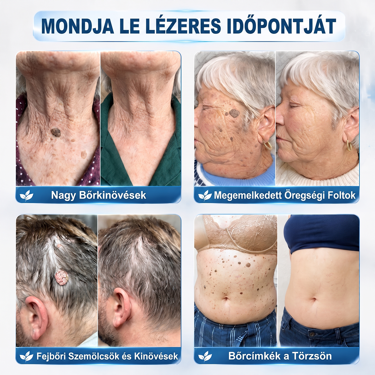 👩‍⚕️👩‍⚕️Hivatalos Márkabolt | 🚢🚢 Hiskin® 7 napos Szemölcseltávolító Roll-on Ápoló Folyadék (Fájdalommentes rollerball technológia, hegek nélkül) 🐬