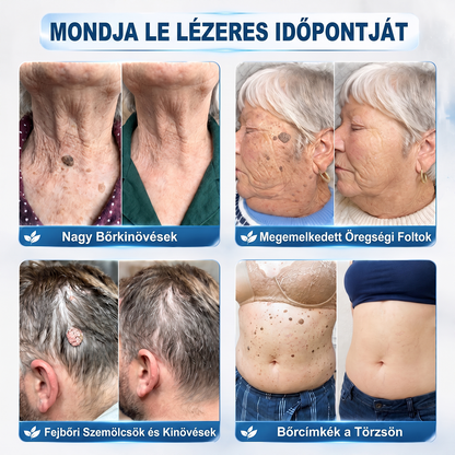 👩‍⚕️👩‍⚕️Hivatalos Márkabolt | 🚢🚢 Hiskin® 7 napos Szemölcseltávolító Roll-on Ápoló Folyadék (Fájdalommentes rollerball technológia, hegek nélkül) 🐬