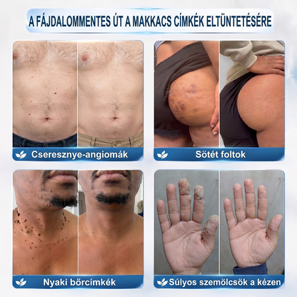 👩‍⚕️👩‍⚕️Hivatalos Márkabolt | 🚢🚢 Hiskin® 7 napos Szemölcseltávolító Roll-on Ápoló Folyadék (Fájdalommentes rollerball technológia, hegek nélkül) 🐬