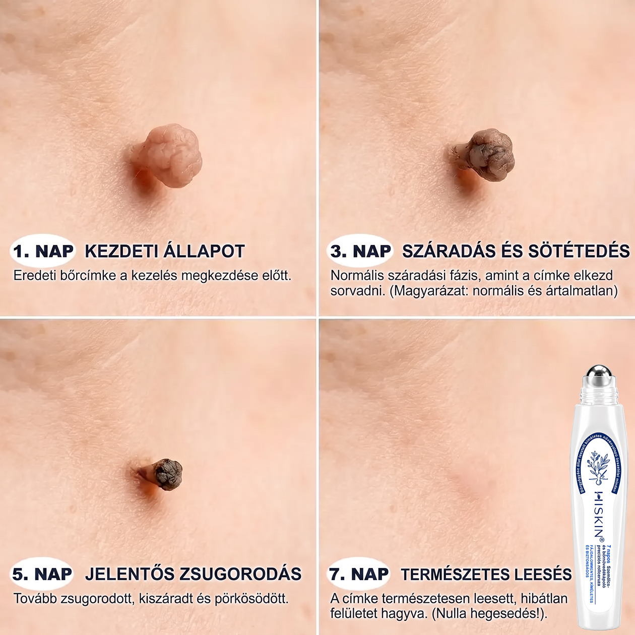👩‍⚕️👩‍⚕️Hivatalos Márkabolt | 🚢🚢 Hiskin® 7 napos Szemölcseltávolító Roll-on Ápoló Folyadék (Fájdalommentes rollerball technológia, hegek nélkül) 🐬