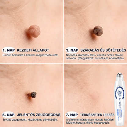 👩‍⚕️👩‍⚕️Hivatalos Márkabolt | 🚢🚢 Hiskin® 7 napos Szemölcseltávolító Roll-on Ápoló Folyadék (Fájdalommentes rollerball technológia, hegek nélkül) 🐬