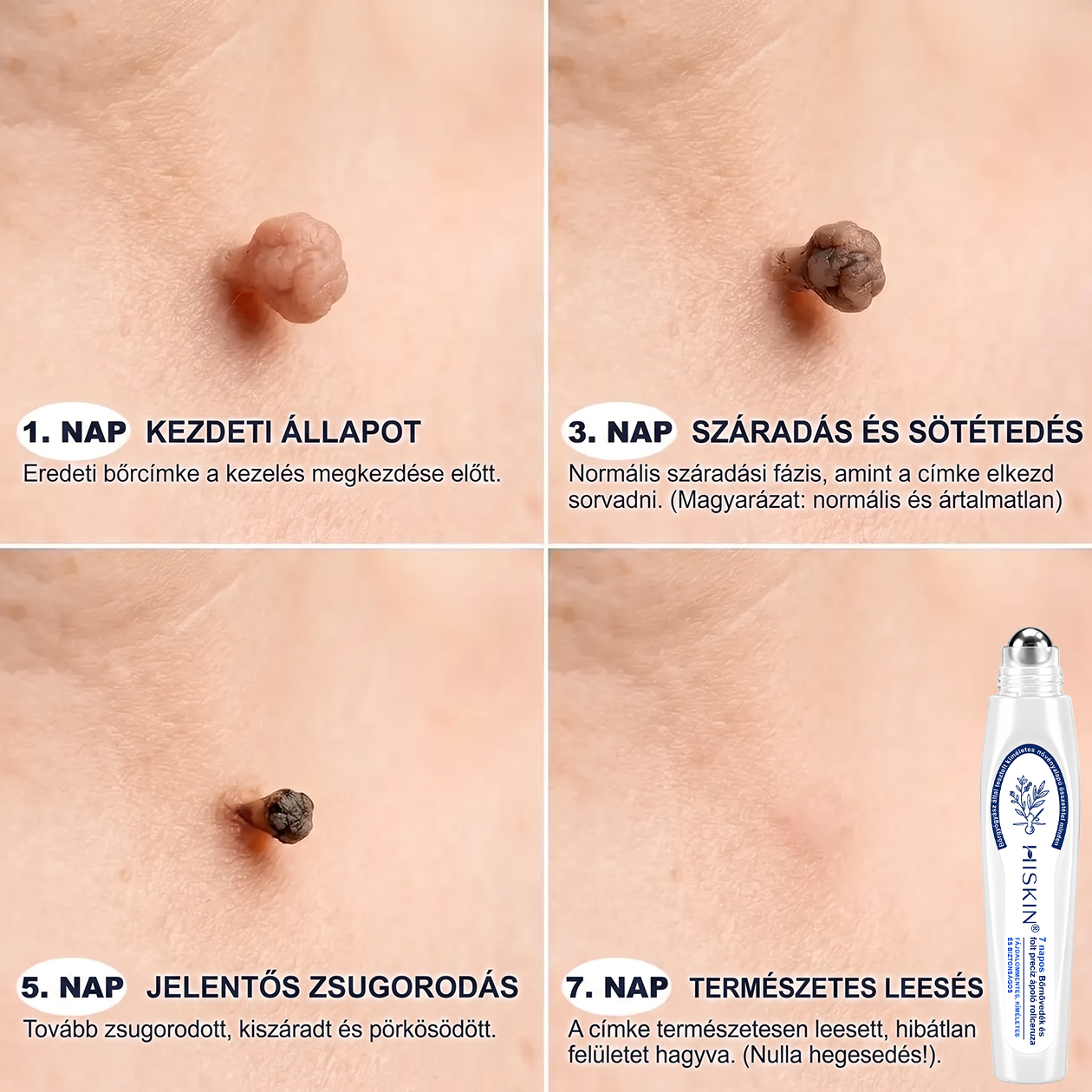 💙💙Hivatalos Márkabolt | 🚢 Hiskin® 7 napos Szemölcseltávolító Roll-on Ápoló Folyadék (Fájdalommentes rollerball technológia, hegek nélkül) 🐬
